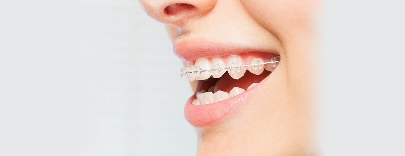 Orthodontics Invisalign