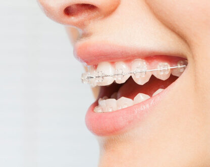 Orthodontics Invisalign