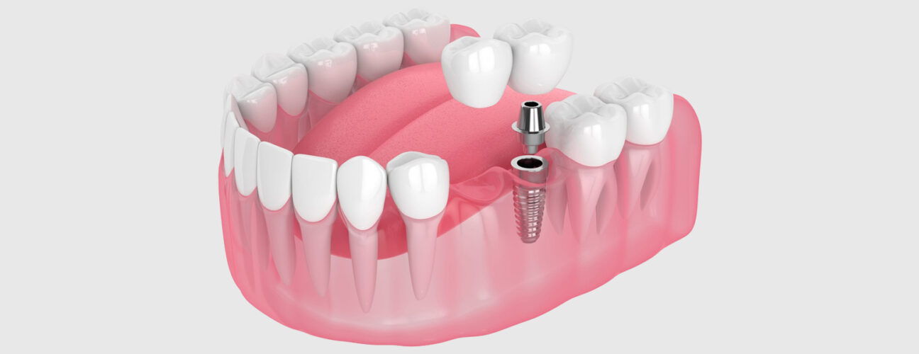 A Few Common Tooth Implant Misconceptions