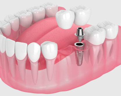 A Few Common Tooth Implant Misconceptions