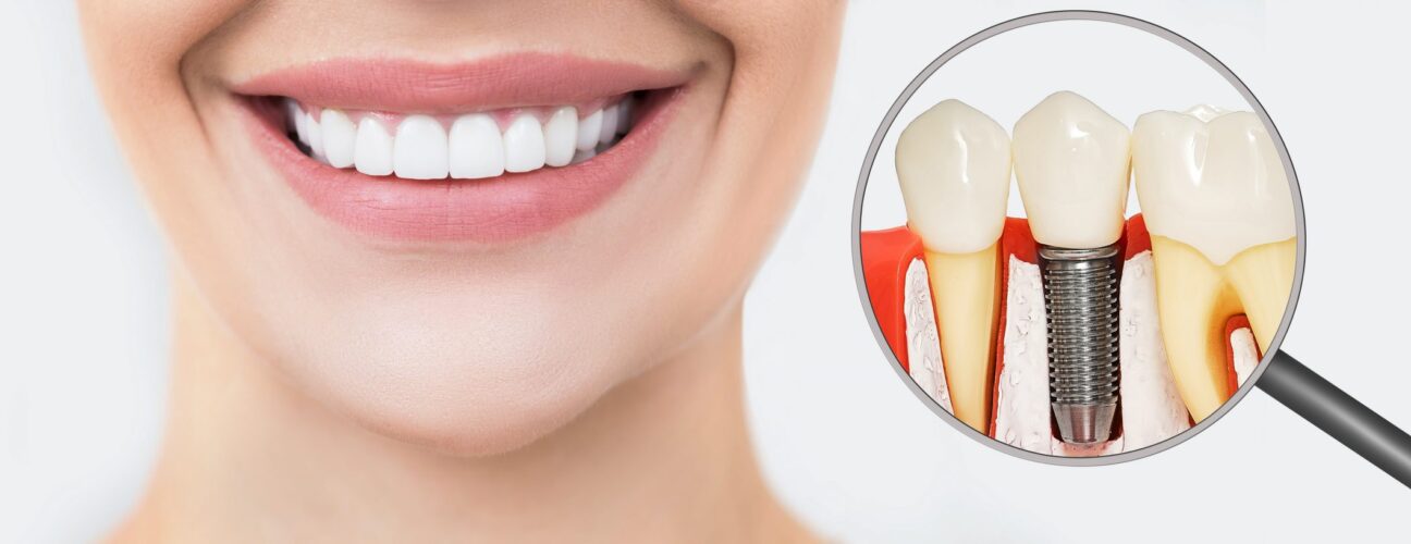 Affordable Dental Implants For You