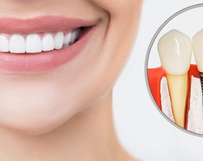 Affordable Dental Implants For You