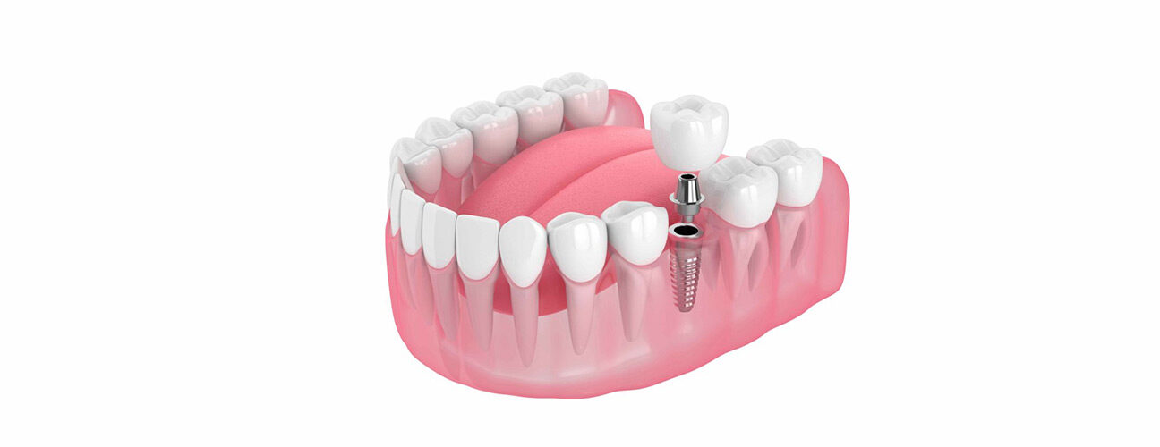 Dental Implants