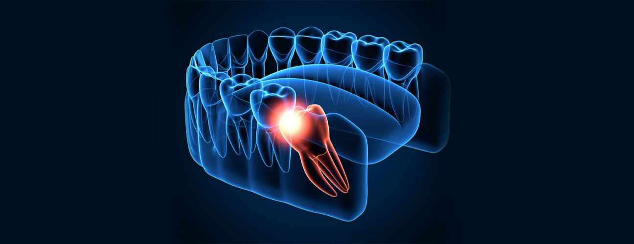 Wisdom-Tooth-pain