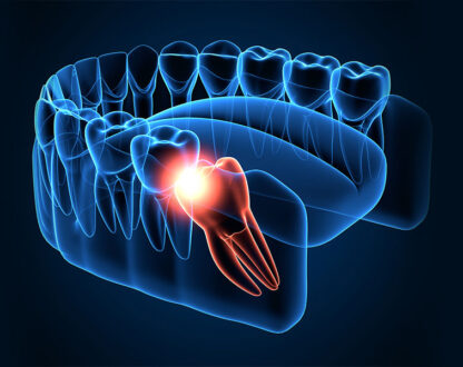 Wisdom-Tooth-pain